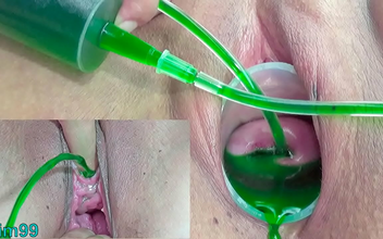 Japanese Lesbian Cervix and Pee Hole Inflation with Injections ~ Exploring New Pleasures